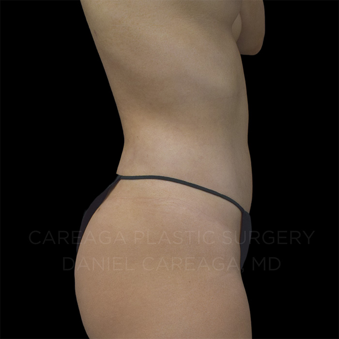 Liposuction-Case--31432 | After Liposuction