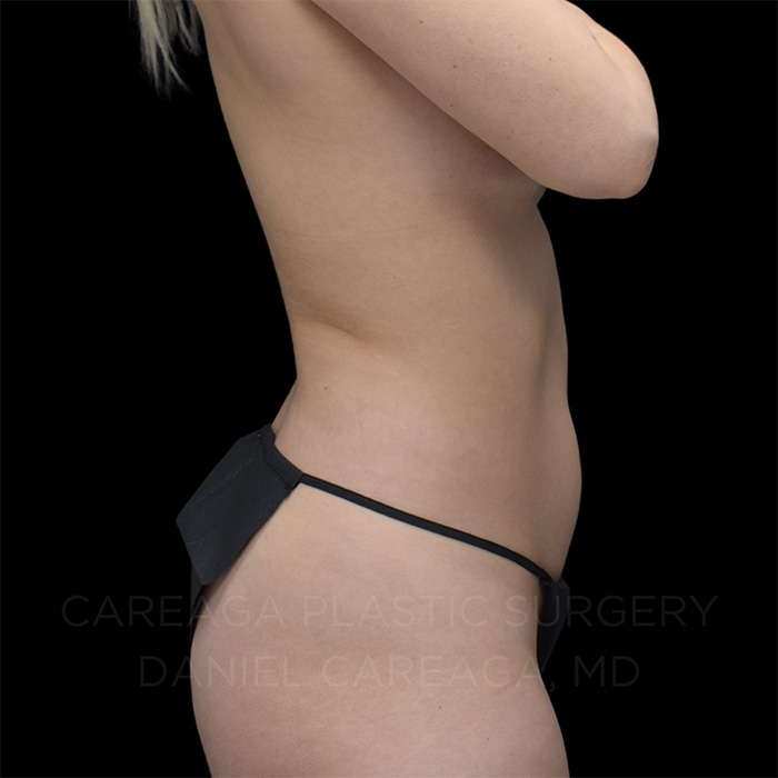Liposuction-Case--31432 | Before Liposuction