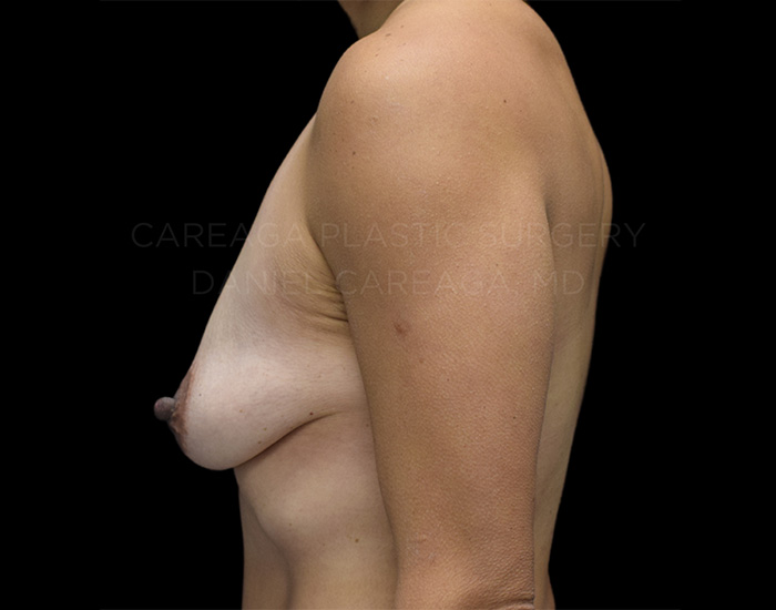 Augmentation-Mastopexy-Case--6999 | Before Augmentation Mastopexy