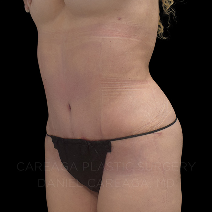 Tummy Tuck Case #8211 after, view 2