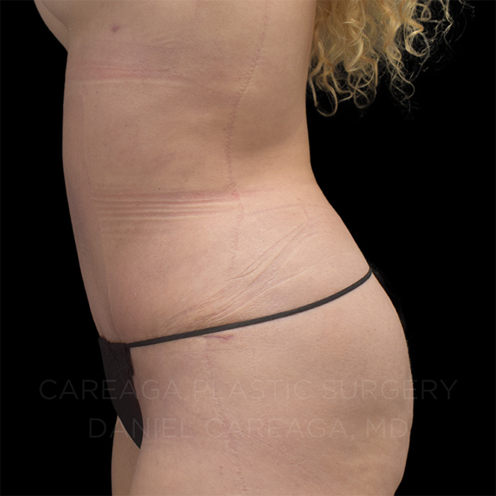 Tummy Tuck Case #8211 after, view 3
