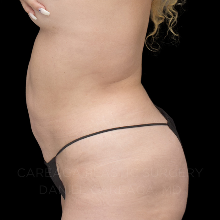 Tummy Tuck Case #8211 before, view 3