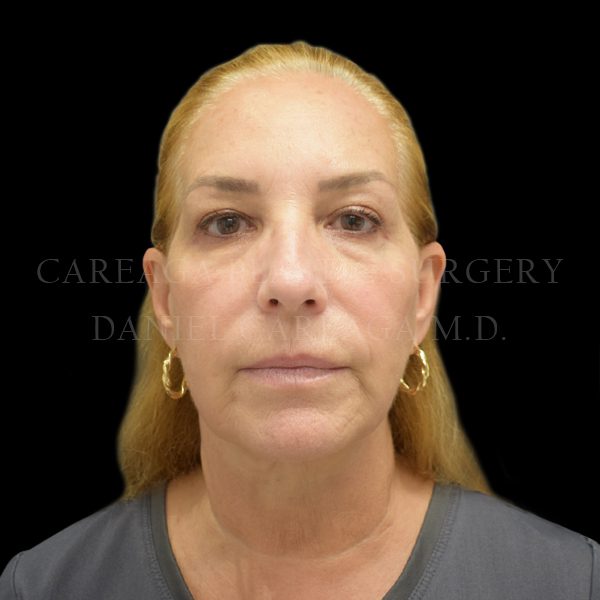 Facelift case 006 after