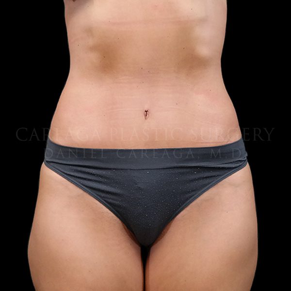 Tummy tuck after