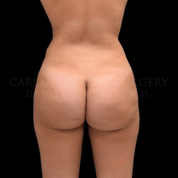 Brazilian Butt Lift Case 006 after