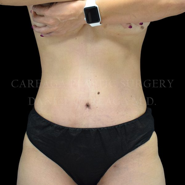 Tummy Tuck case 022 after