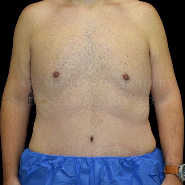Tummy Tuck case 023 after