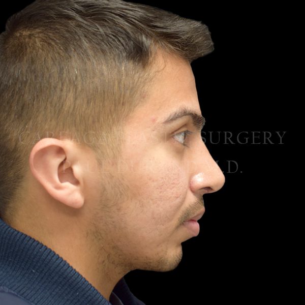 Rhinoplasty case 007 after