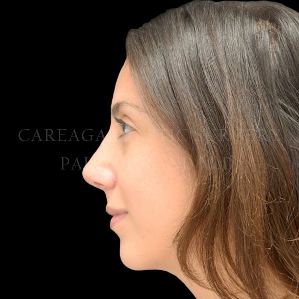 Rhinoplasty case 008 after