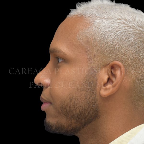 Rhinoplasty case 009 after