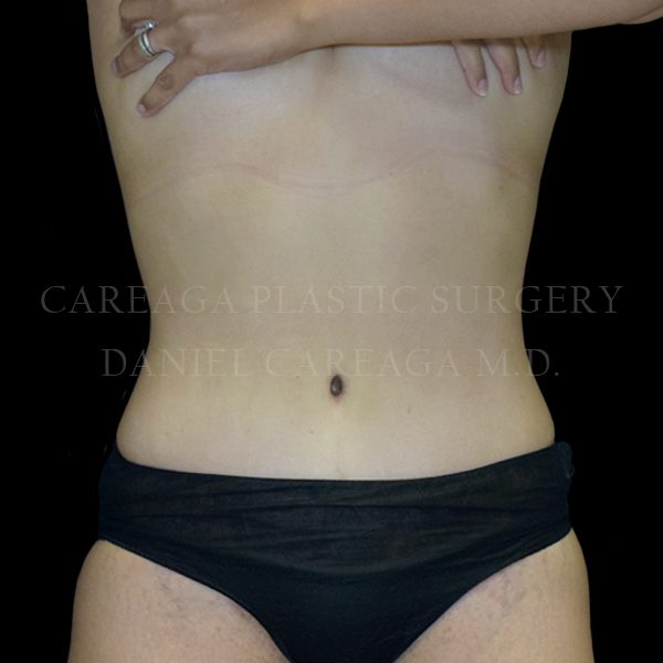 Tummy Tuck case 024 after