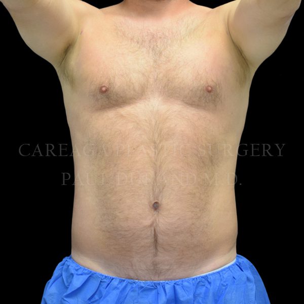 Liposuction case 007 after