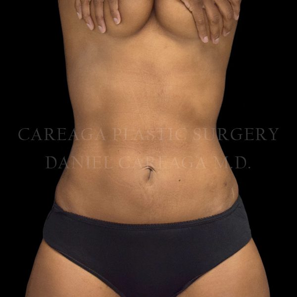 Liposuction case 008 after