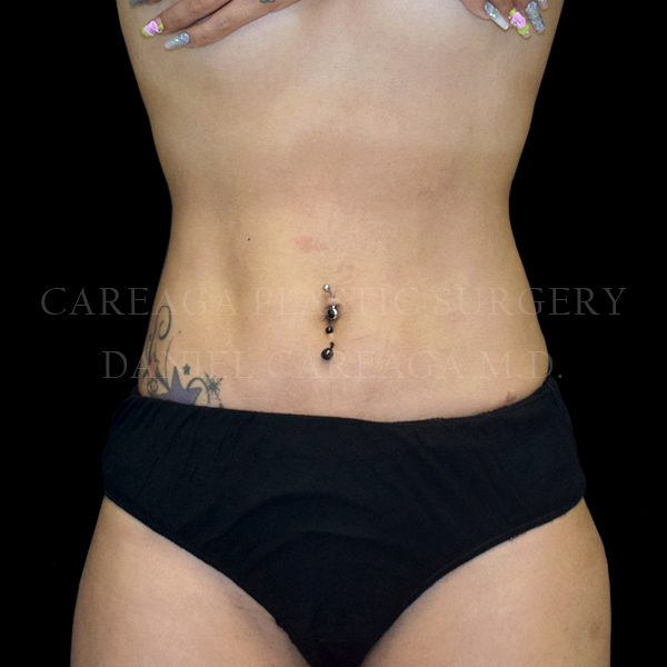 Liposuction case 009 after