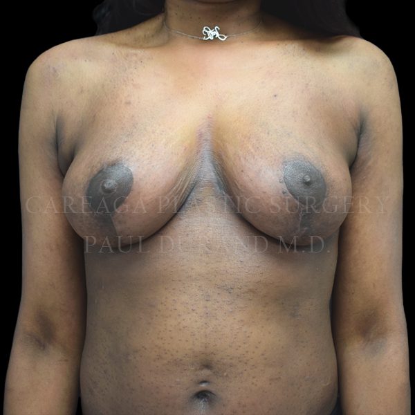 Breast Lift case 005 after