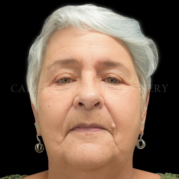 Blepharoplasty case 001 after