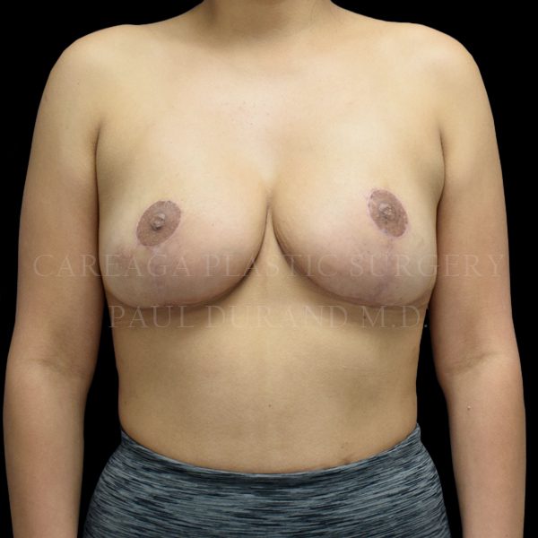 Breast Reduction case 004 after