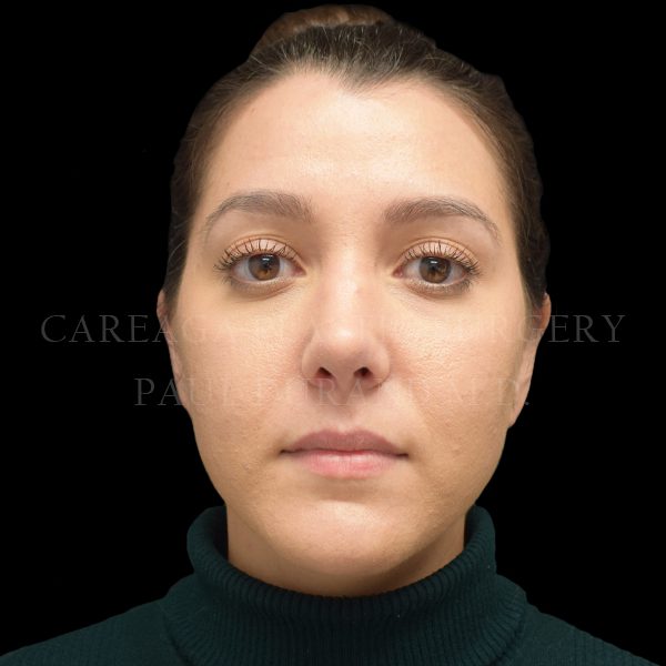 Rhinoplasty case 010 after