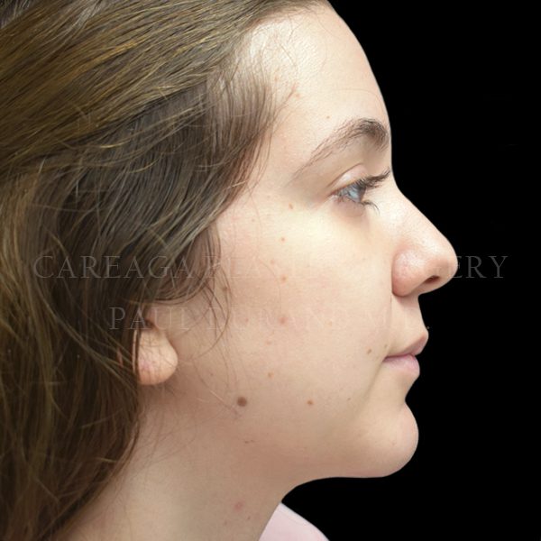 Chin Implant case 001 after