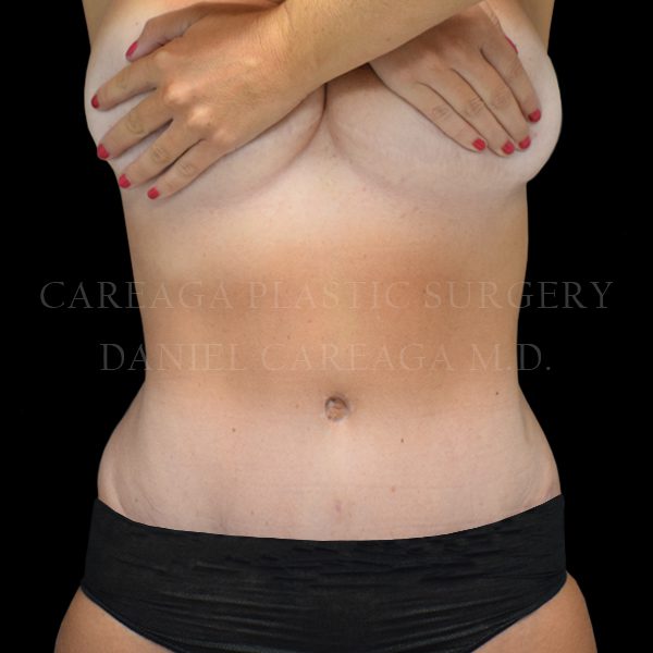 Tummy Tuck case 025 after