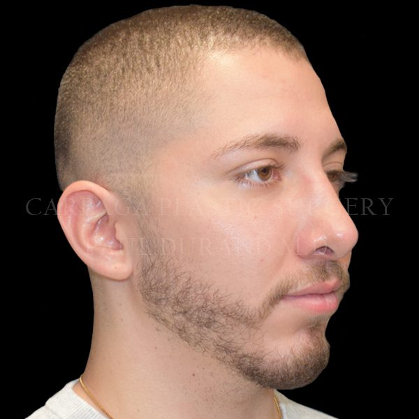 Rhinoplasty case 011 after