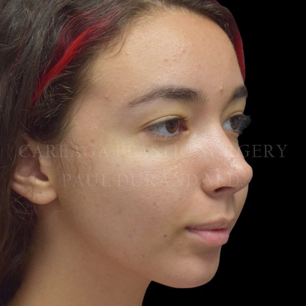 Rhinoplasty case 012 after