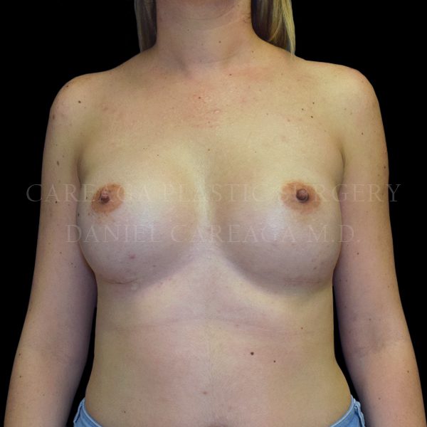 Breast Augmentation case 020 after