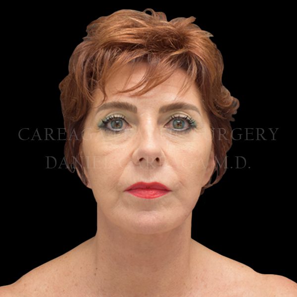 Facelift case 007 after