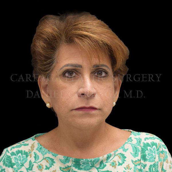 Facelift case 008 after