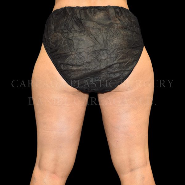 Cellulaze case 002 after