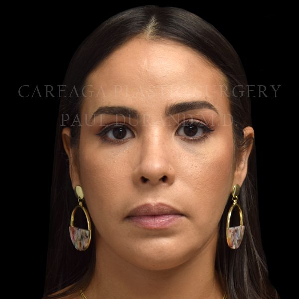 Rhinoplasty case 013 after