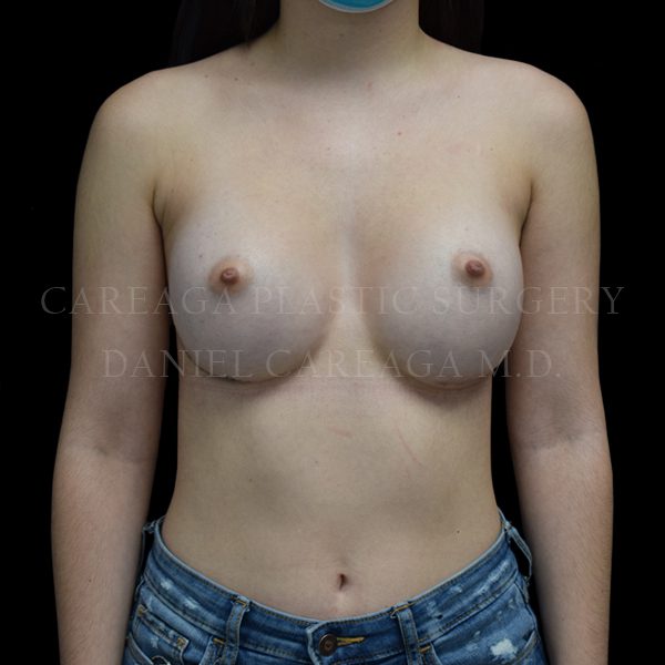 Breast Augmentation case 021 after