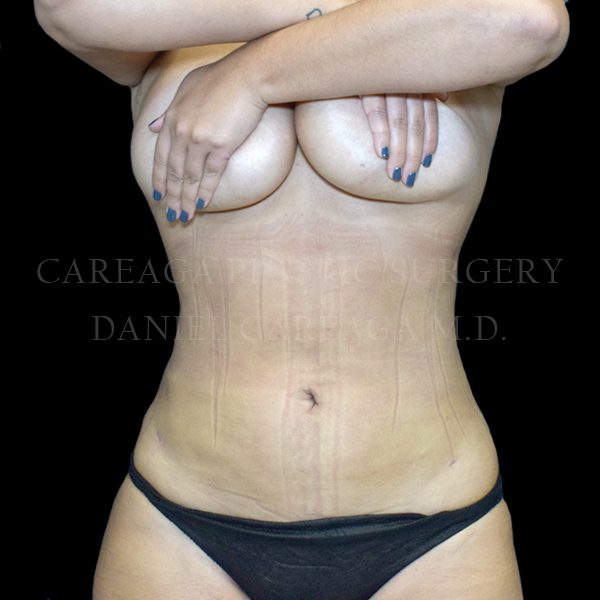 Liposuction case 011 after