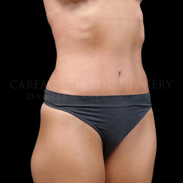 Tummy Tuck Case 5916 after, view 2