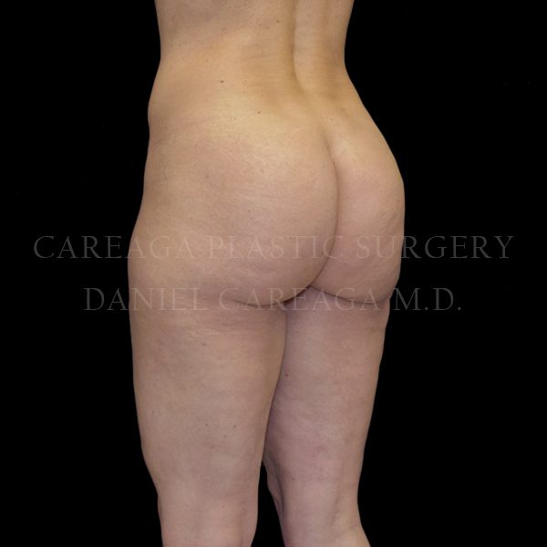 Cellulaze case 001 after, view 2