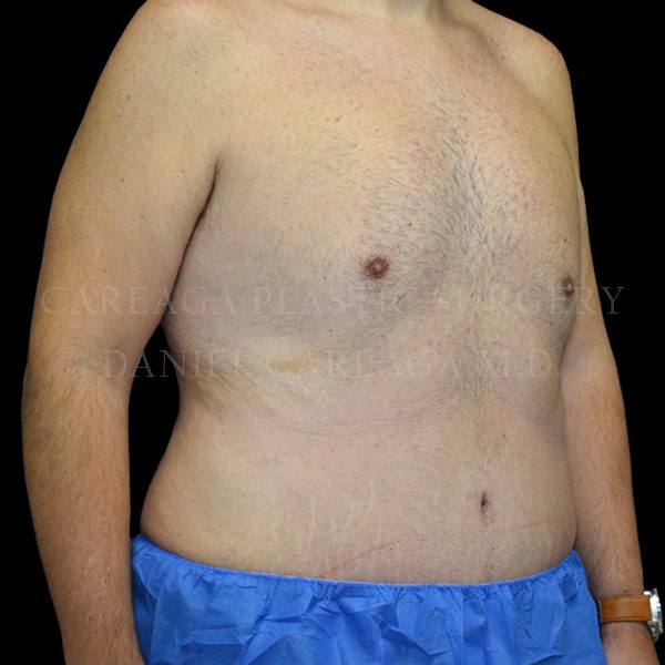 Tummy Tuck case 023 after, view 2