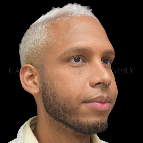 Rhinoplasty case 009 after, view 2