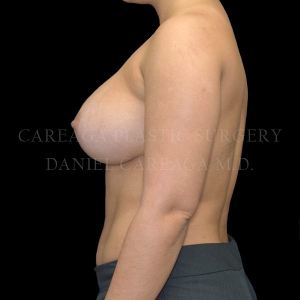 Breast Augmentation case 016 after, view 2