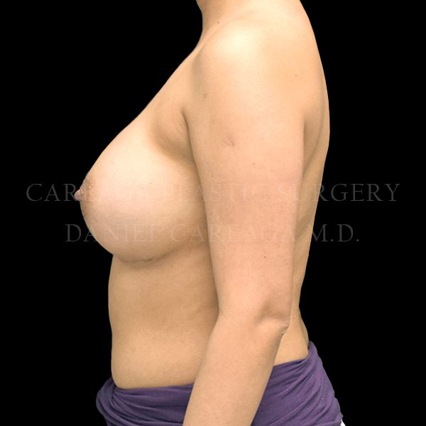 Breast Augmentation case 017 after, view 2