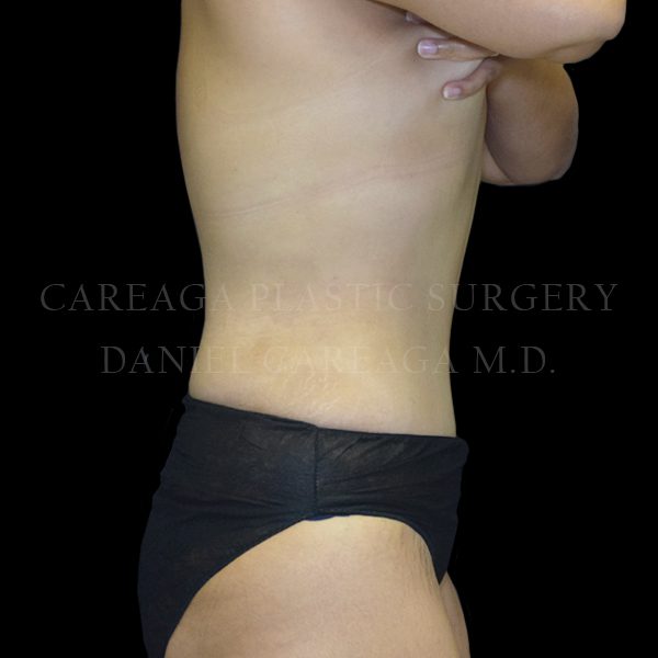 Tummy Tuck case 024 after, view 2