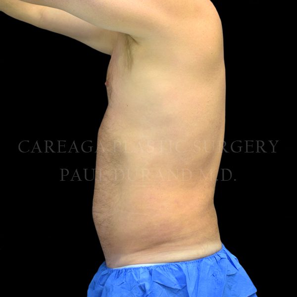 Liposuction case 007 after, view 2