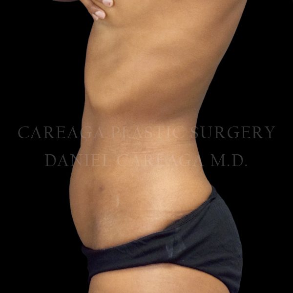 Liposuction case 008 after, view 2