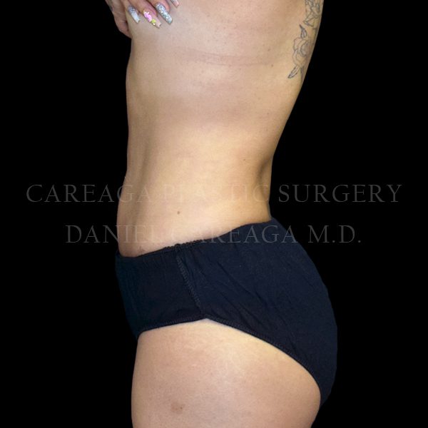 Liposuction case 009 after, view 2
