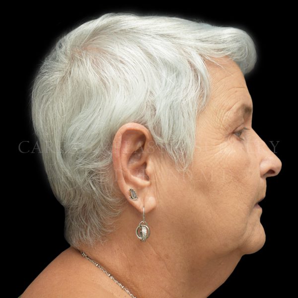 Blepharoplasty case 001 after, view 2