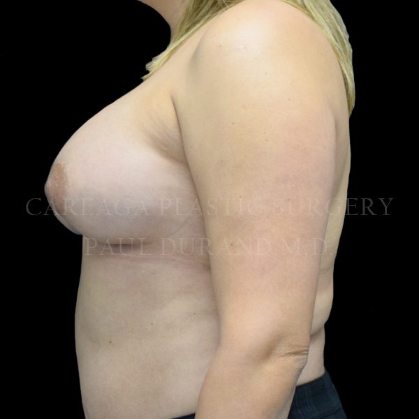 Breast Augmentation case 018 after, view 2