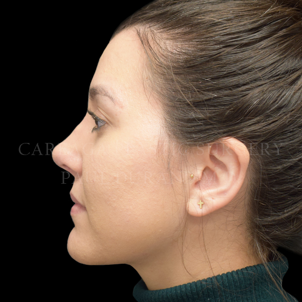 Rhinoplasty case 010 after, view 2