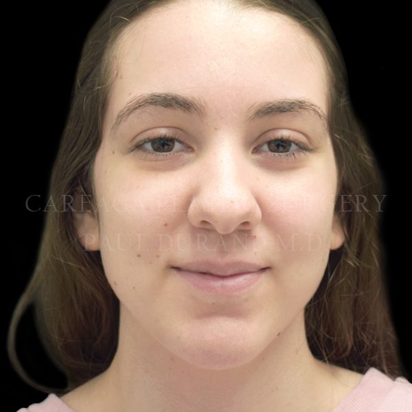 Chin Implant case 001 after, view 2