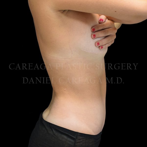 Tummy Tuck case 025 after, view 2