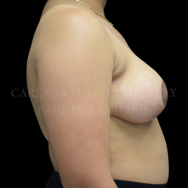 Breast Reduction case 005 after, view 2