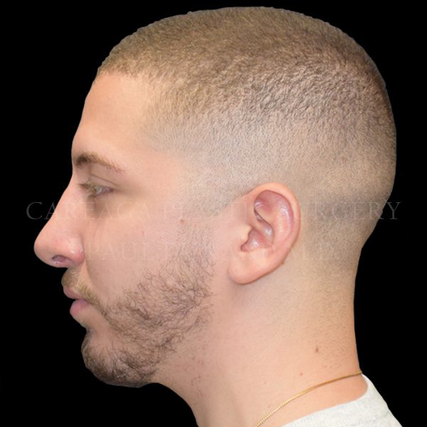 Rhinoplasty case 011 after, view 2
